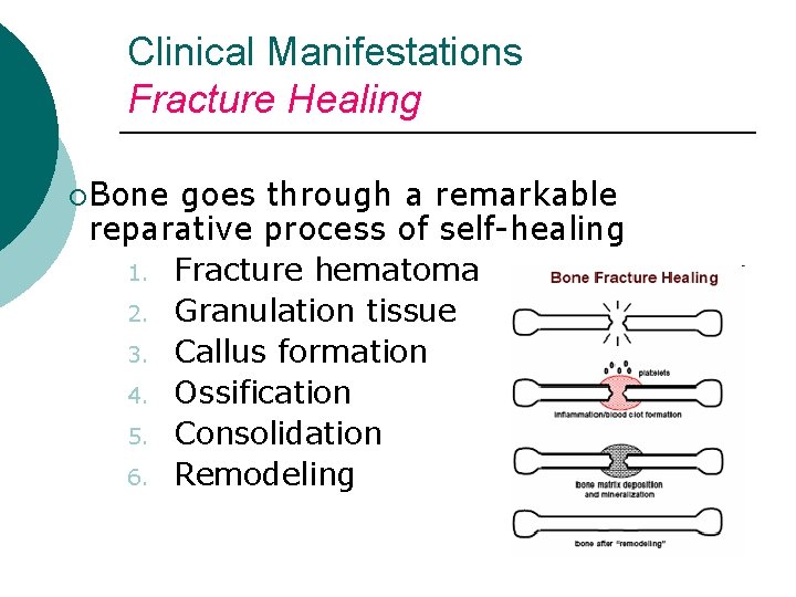 Clinical Manifestations Fracture Healing ¡Bone goes through a remarkable reparative process of self-healing 1.