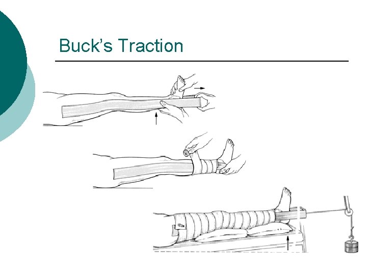 Buck’s Traction 