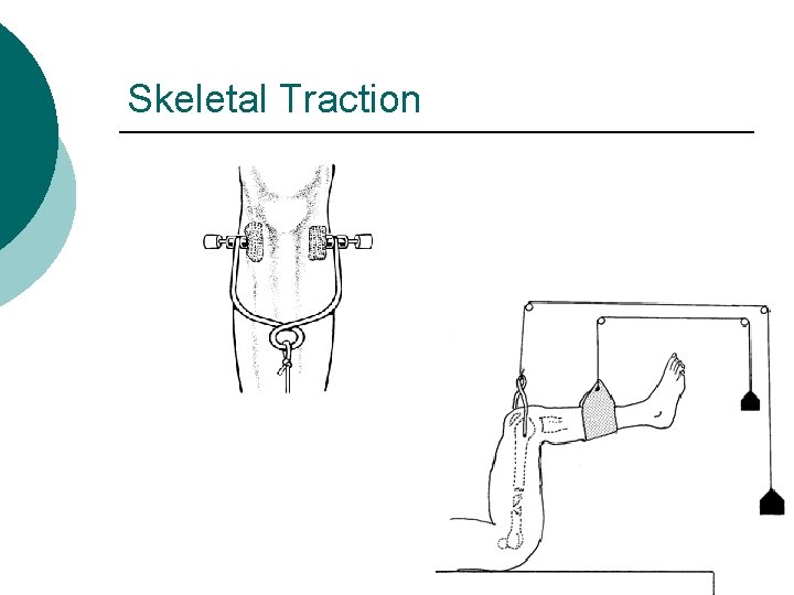 Skeletal Traction 