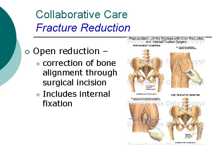 Collaborative Care Fracture Reduction ¡ Open reduction – l l correction of bone alignment