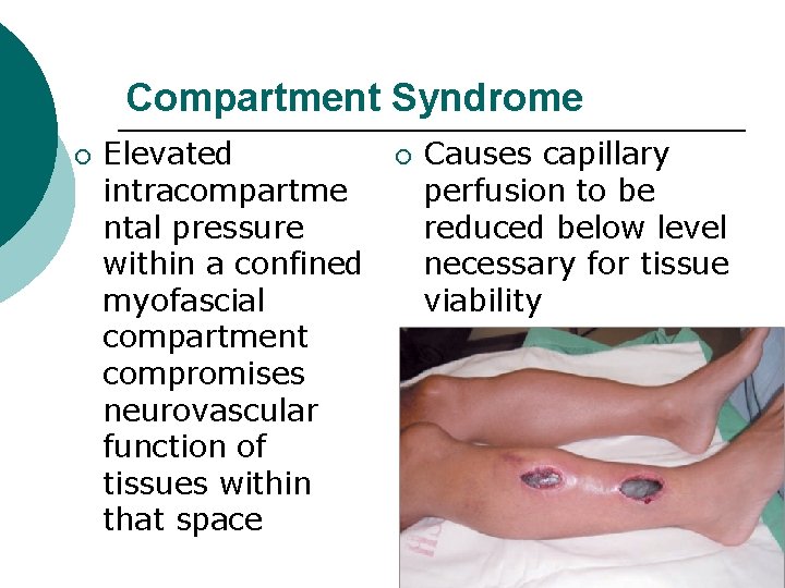 Compartment Syndrome ¡ Elevated intracompartme ntal pressure within a confined myofascial compartment compromises neurovascular