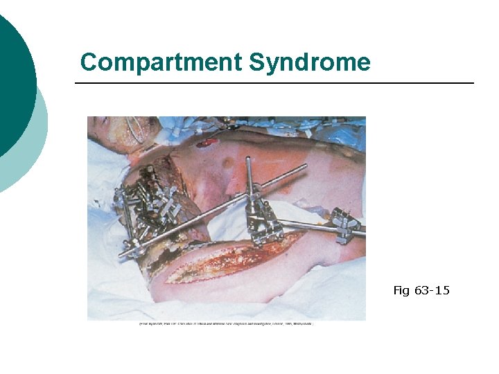 Compartment Syndrome Fig 63 -15 