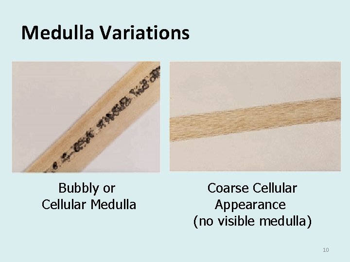 Medulla Variations Bubbly or Cellular Medulla Coarse Cellular Appearance (no visible medulla) 10 