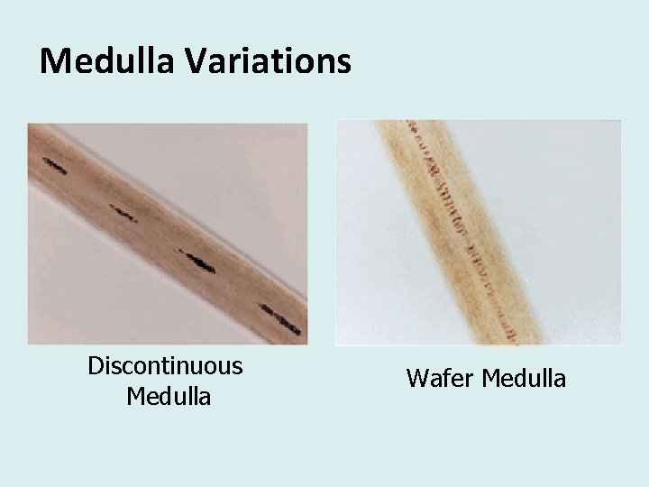 Medulla Variations Discontinuous Medulla Wafer Medulla 