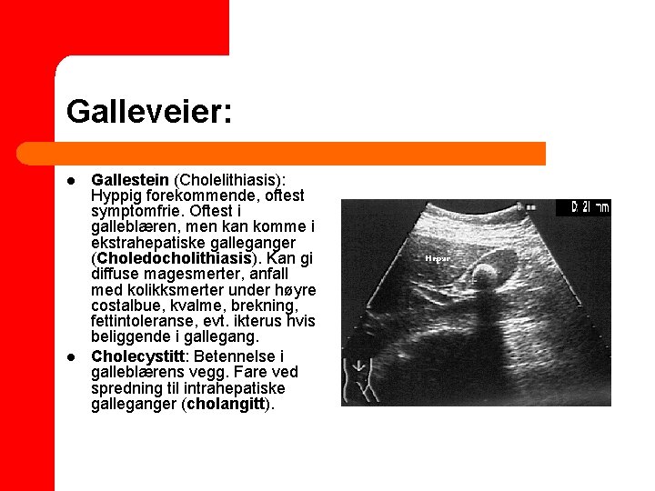 Galleveier: l l Gallestein (Cholelithiasis): Hyppig forekommende, oftest symptomfrie. Oftest i galleblæren, men kan