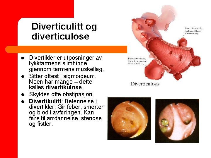 Diverticulitt og diverticulose l l Divertikler er utposninger av tykktarmens slimhinne gjennom tarmens muskellag.