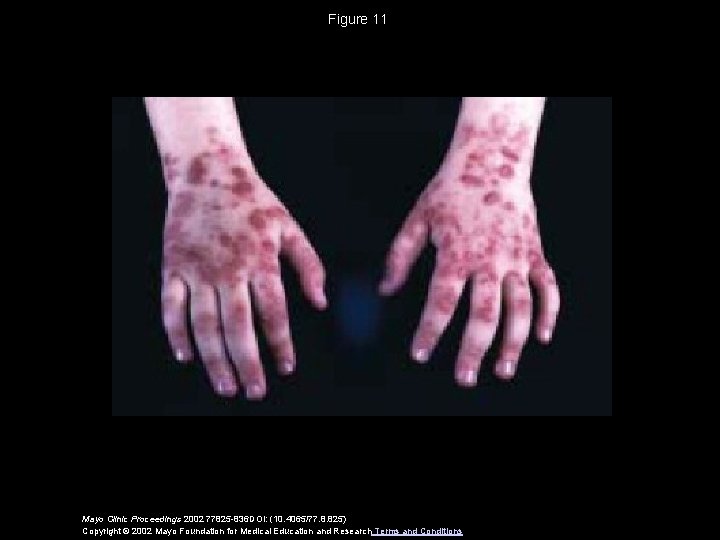 Figure 11 Mayo Clinic Proceedings 2002 77825 -836 DOI: (10. 4065/77. 8. 825) Copyright