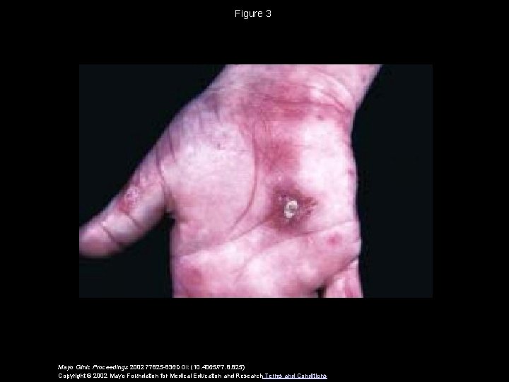 Figure 3 Mayo Clinic Proceedings 2002 77825 -836 DOI: (10. 4065/77. 8. 825) Copyright