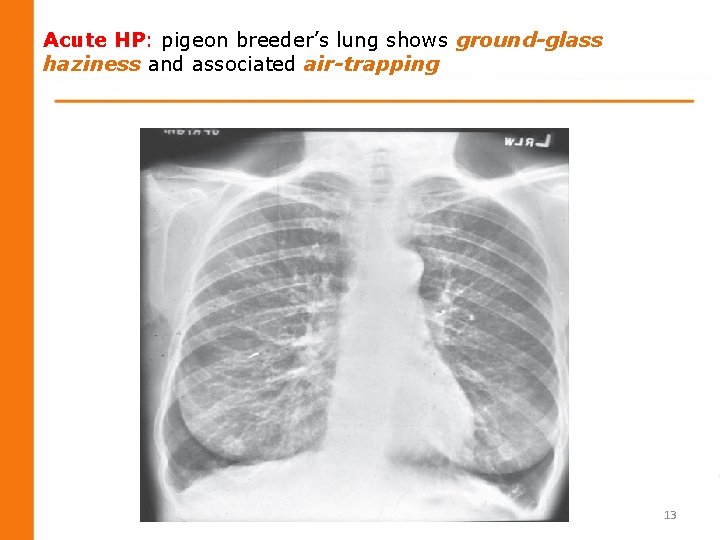 Acute HP: pigeon breeder’s lung shows ground-glass haziness and associated air-trapping 13 