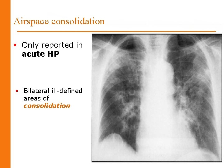 Airspace consolidation § Only reported in acute HP § Bilateral ill-defined areas of consolidation