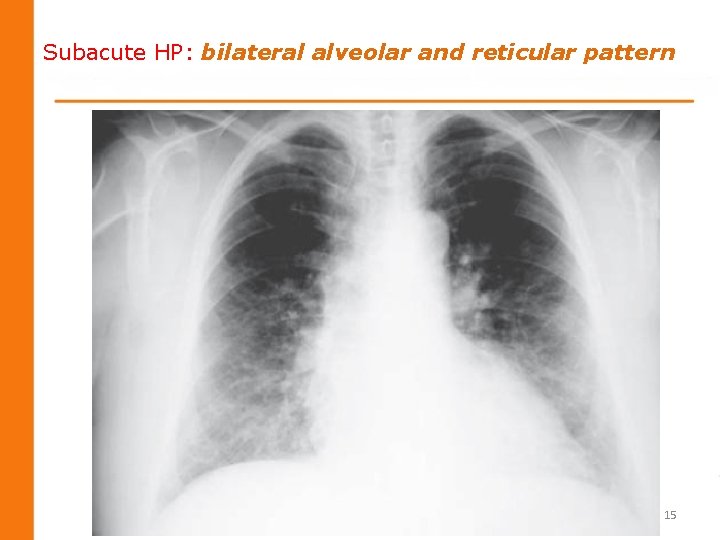 Subacute HP: bilateral alveolar and reticular pattern 15 