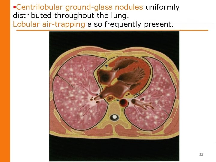 §Centrilobular ground-glass nodules uniformly distributed throughout the lung. Lobular air-trapping also frequently present. 22