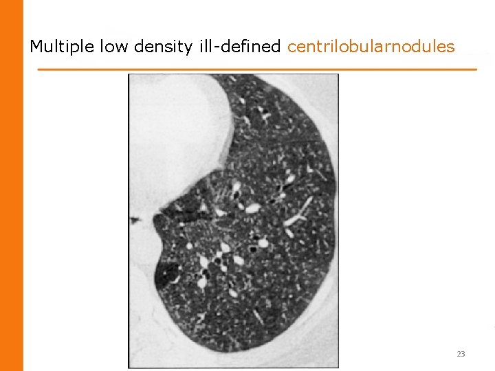 Multiple low density ill-defined centrilobularnodules 23 Multiple low density ill-defined centrilobularnodules 23