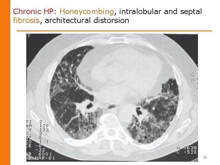 Chronic HP: Honeycombing, intralobular and septal fibrosis, architectural distorsion 25 