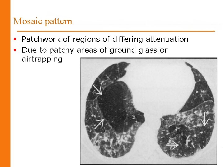 Mosaic pattern § Patchwork of regions of differing attenuation § Due to patchy areas