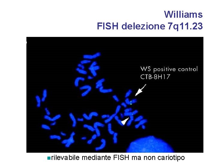 Williams FISH delezione 7 q 11. 23 nrilevabile mediante FISH ma non cariotipo 