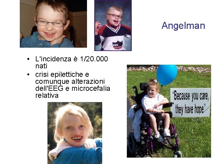 Angelman • L'incidenza è 1/20. 000 nati • crisi epilettiche e comunque alterazioni dell'EEG