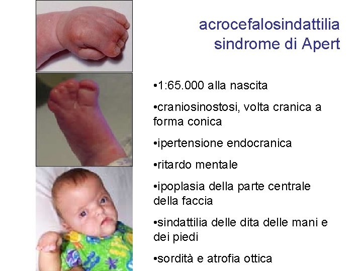 acrocefalosindattilia sindrome di Apert • 1: 65. 000 alla nascita • craniosinostosi, volta cranica