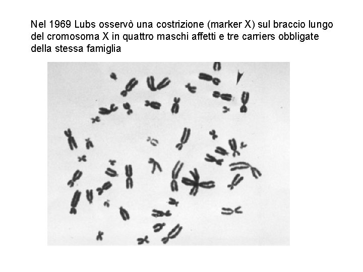 Nel 1969 Lubs osservò una costrizione (marker X) sul braccio lungo del cromosoma X