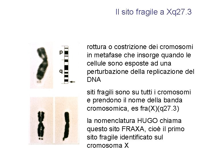 Il sito fragile a Xq 27. 3 rottura o costrizione dei cromosomi in metafase