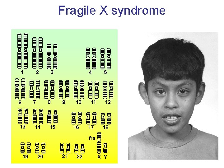 Fragile X syndrome 