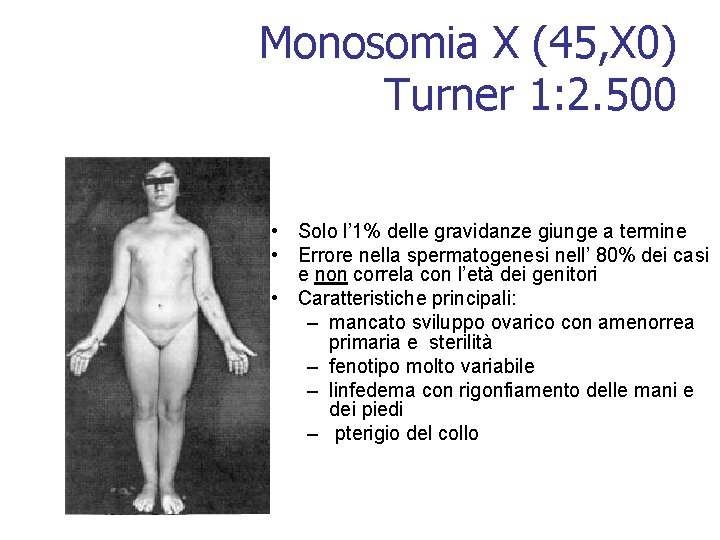 Monosomia X (45, X 0) Turner 1: 2. 500 • Solo l’ 1% delle