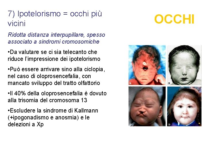 7) Ipotelorismo = occhi più vicini Ridotta distanza interpupillare, spesso associato a sindromi cromosomiche