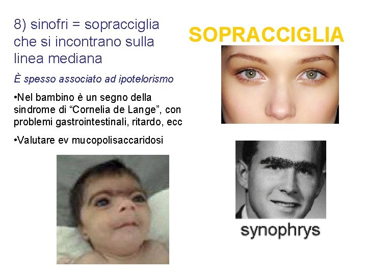 8) sinofri = sopracciglia che si incontrano sulla linea mediana È spesso associato ad