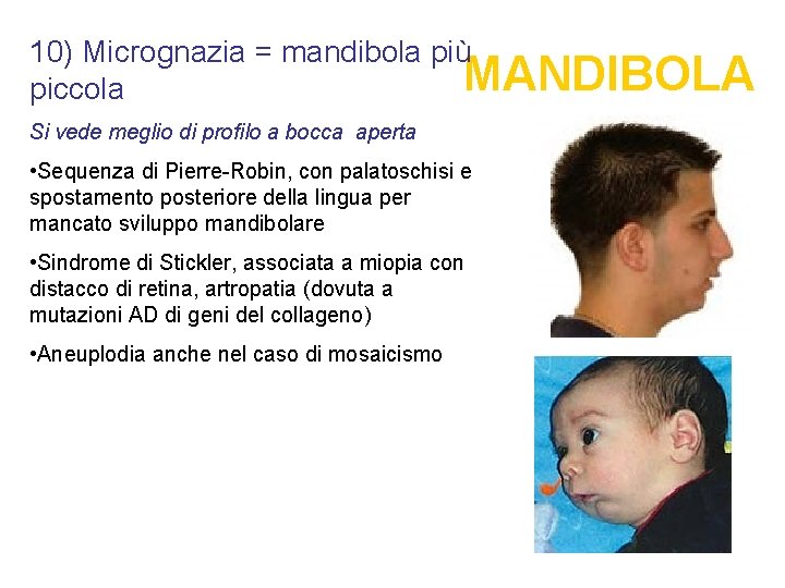 10) Micrognazia = mandibola più MANDIBOLA piccola Si vede meglio di profilo a bocca