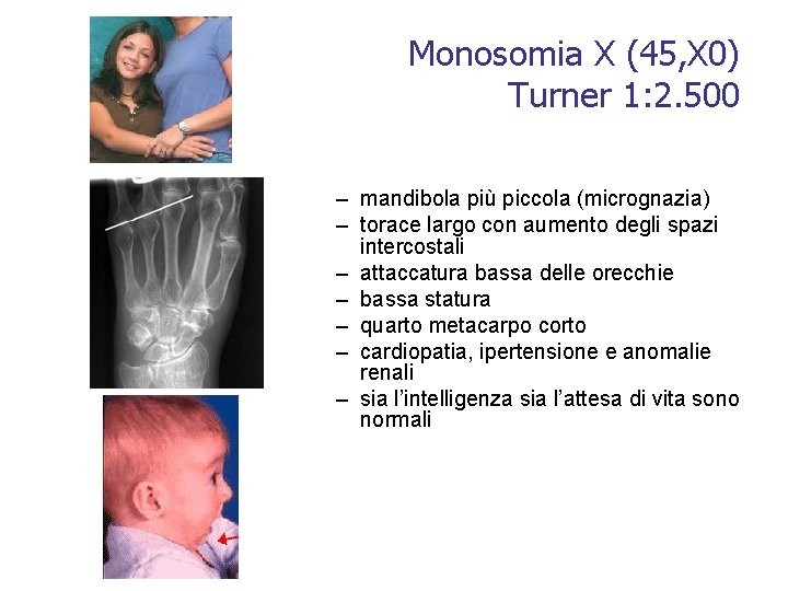 Monosomia X (45, X 0) Turner 1: 2. 500 – mandibola più piccola (micrognazia)