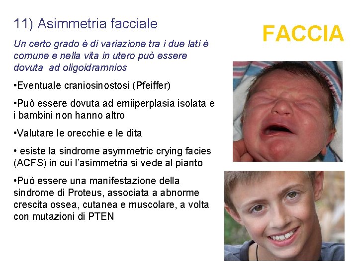 11) Asimmetria facciale Un certo grado è di variazione tra i due lati è