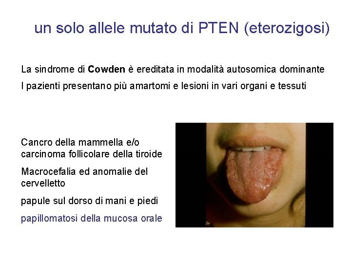 un solo allele mutato di PTEN (eterozigosi) La sindrome di Cowden è ereditata in