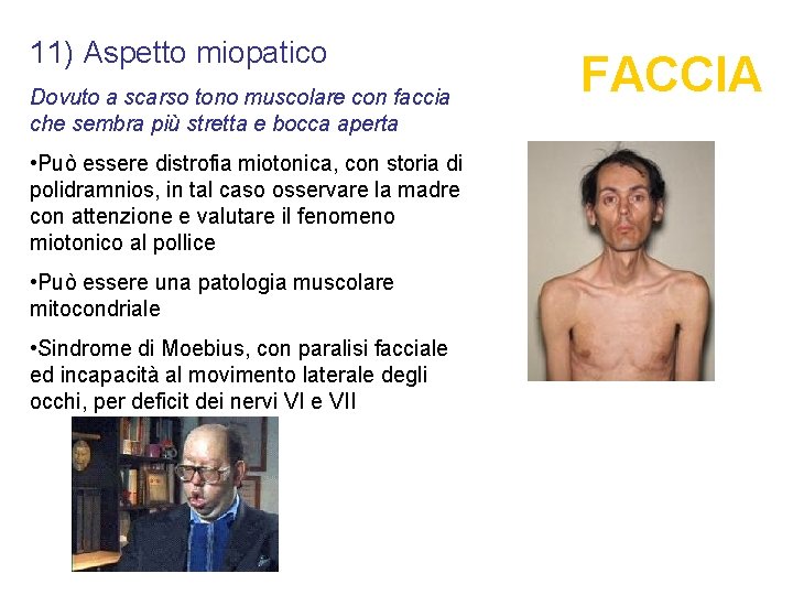 11) Aspetto miopatico Dovuto a scarso tono muscolare con faccia che sembra più stretta