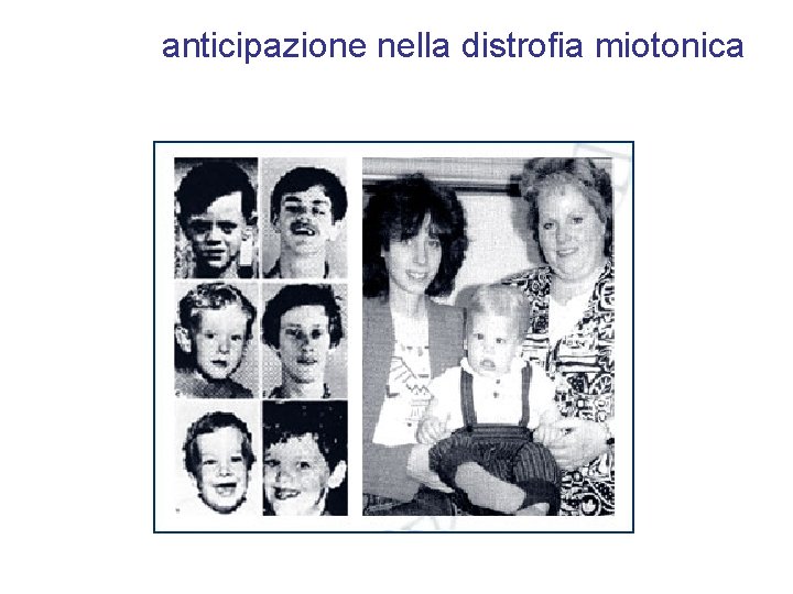 anticipazione nella distrofia miotonica 
