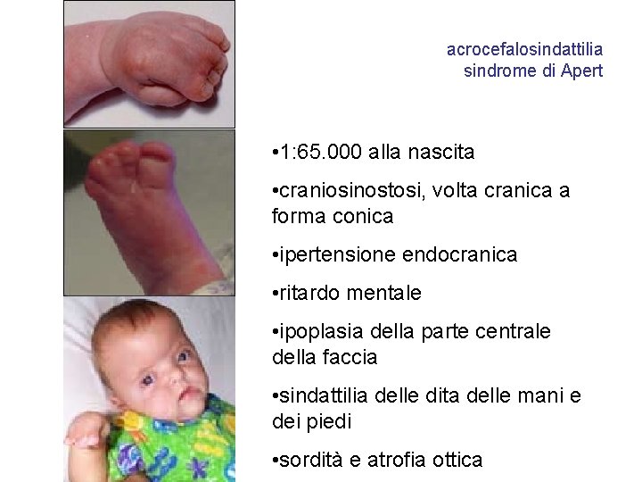 acrocefalosindattilia sindrome di Apert • 1: 65. 000 alla nascita • craniosinostosi, volta cranica