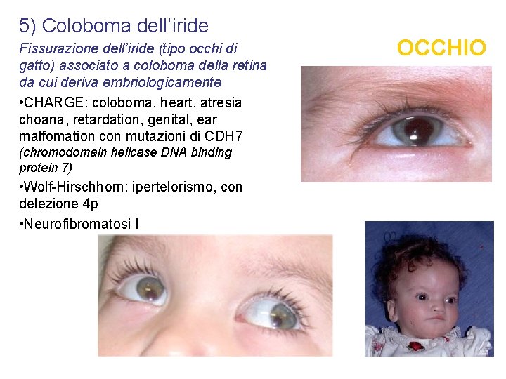 5) Coloboma dell’iride Fissurazione dell’iride (tipo occhi di gatto) associato a coloboma della retina