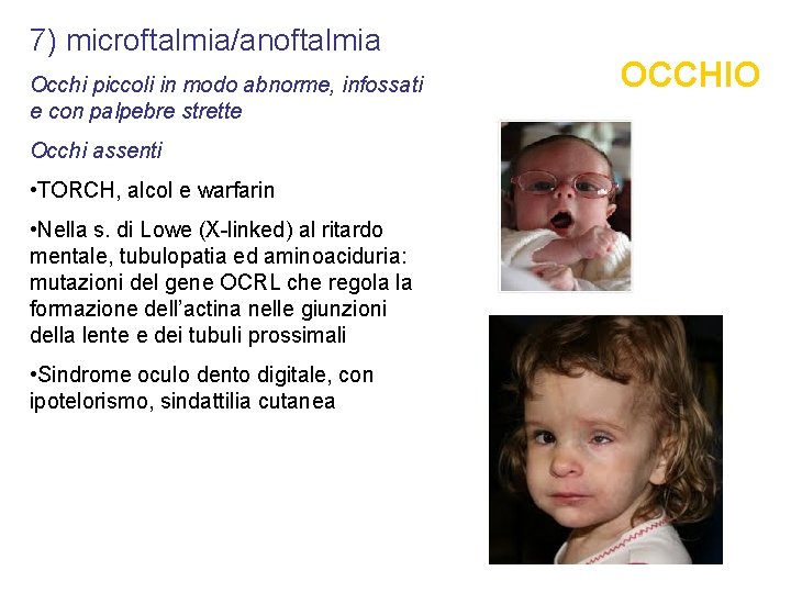 7) microftalmia/anoftalmia Occhi piccoli in modo abnorme, infossati e con palpebre strette Occhi assenti