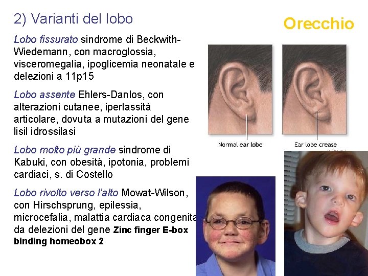 2) Varianti del lobo Lobo fissurato sindrome di Beckwith. Wiedemann, con macroglossia, visceromegalia, ipoglicemia