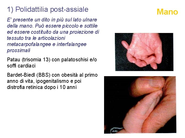 1) Polidattilia post-assiale E’ presente un dito in più sul lato ulnare della mano.