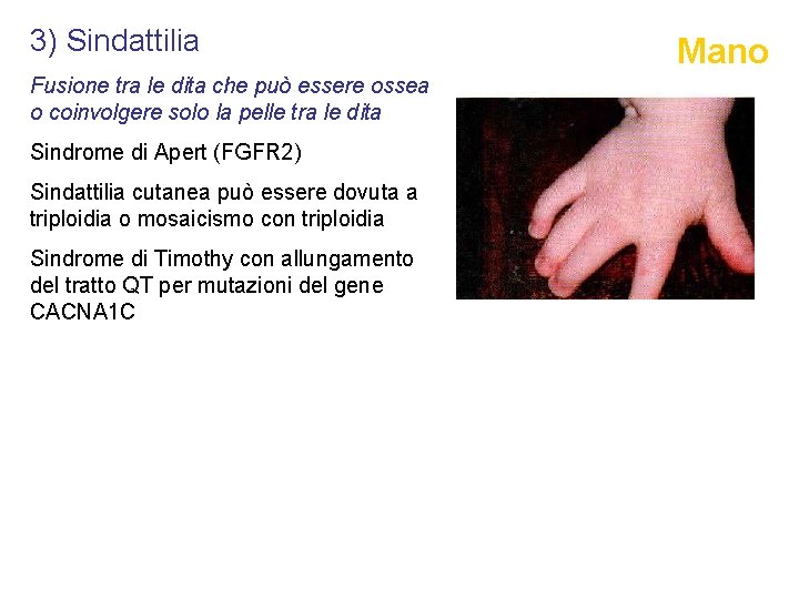 3) Sindattilia Fusione tra le dita che può essere ossea o coinvolgere solo la