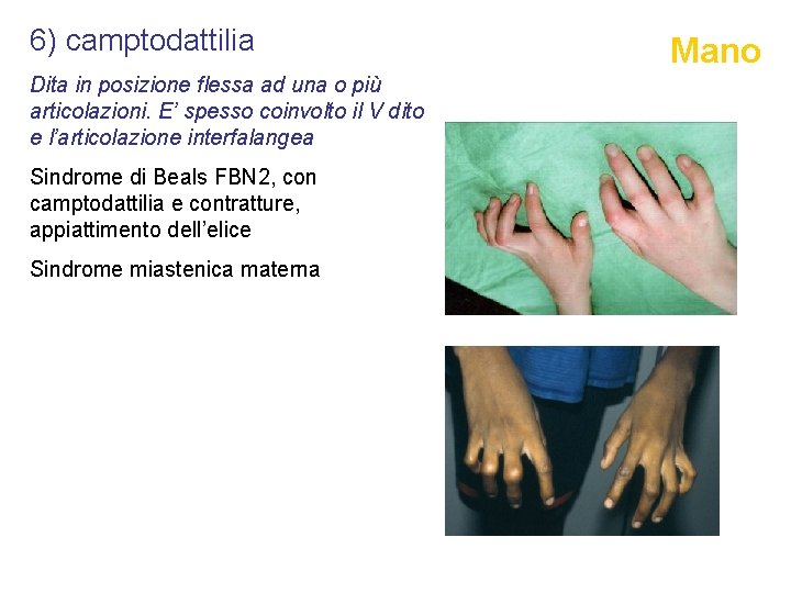 6) camptodattilia Dita in posizione flessa ad una o più articolazioni. E’ spesso coinvolto