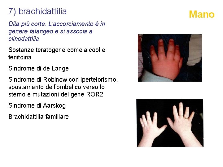 7) brachidattilia Dita più corte. L’accorciamento è in genere falangeo e si associa a