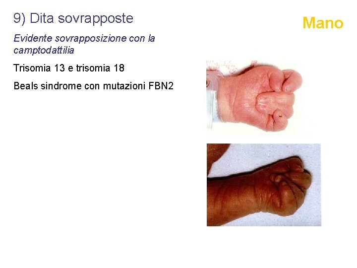 9) Dita sovrapposte Evidente sovrapposizione con la camptodattilia Trisomia 13 e trisomia 18 Beals