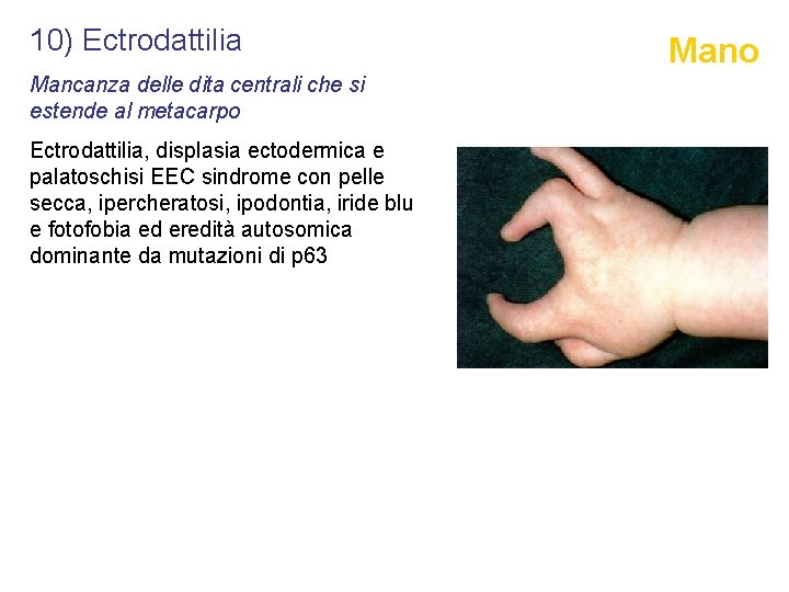 10) Ectrodattilia Mancanza delle dita centrali che si estende al metacarpo Ectrodattilia, displasia ectodermica