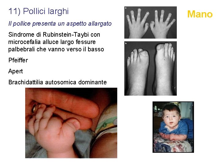 11) Pollici larghi Il pollice presenta un aspetto allargato Sindrome di Rubinstein-Taybi con microcefalia