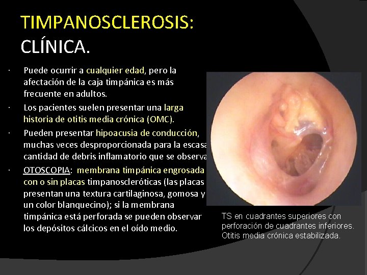 TIMPANOSCLEROSIS A Estremera R H Sarasibar E G