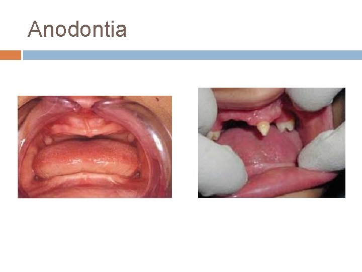 Anodontia 