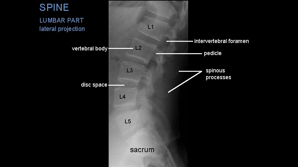 SPINE LUMBAR PART L 1 lateral projection intervertebral foramen L 2 vertebral body L