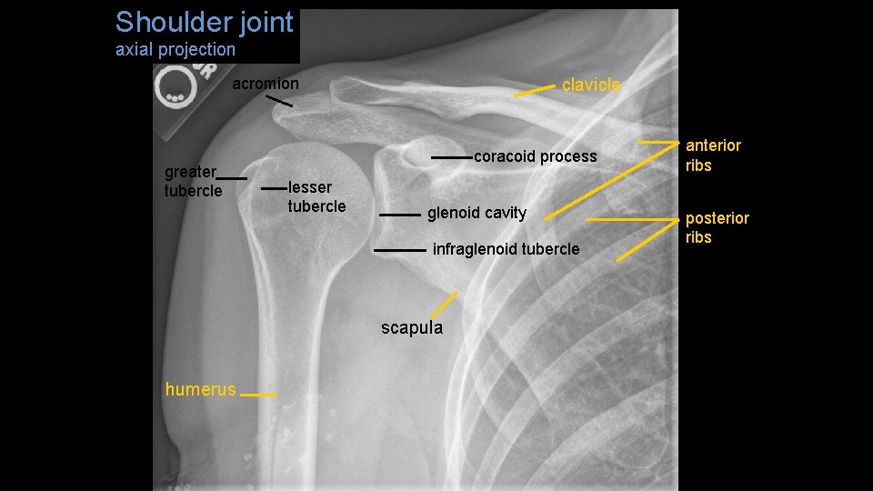 Shoulder joint axial projection acromion greater tubercle clavicle coracoid process lesser tubercle glenoid cavity