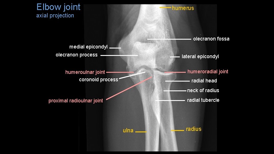 Elbow joint humerus axial projection olecranon fossa medial epicondyl olecranon process lateral epicondyl humeroradial